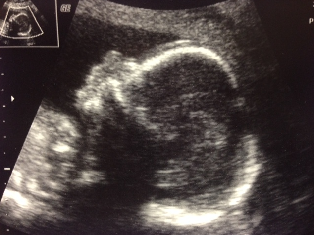 An ultrasound shows the development of science teacher Staci Killingsworth’s baby at 19 weeks. 