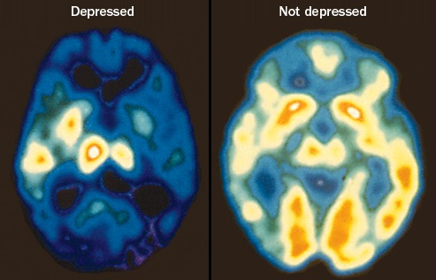 These PET scan images compare the brain of a patient with depression and the brain of a patient without. The decrease in red and white areas indicates a decrease in brain activity because of the disorder, which student Susan Smith has struggled with for three years. 