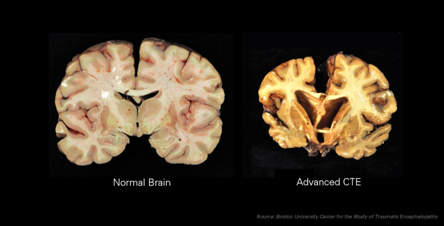 As National Football League Commissioner Roger Goodell continues to deny the truth, people will begin to deny his leadership.  Players’ health, specifically regarding CTE and concussions, should be the number one priority.